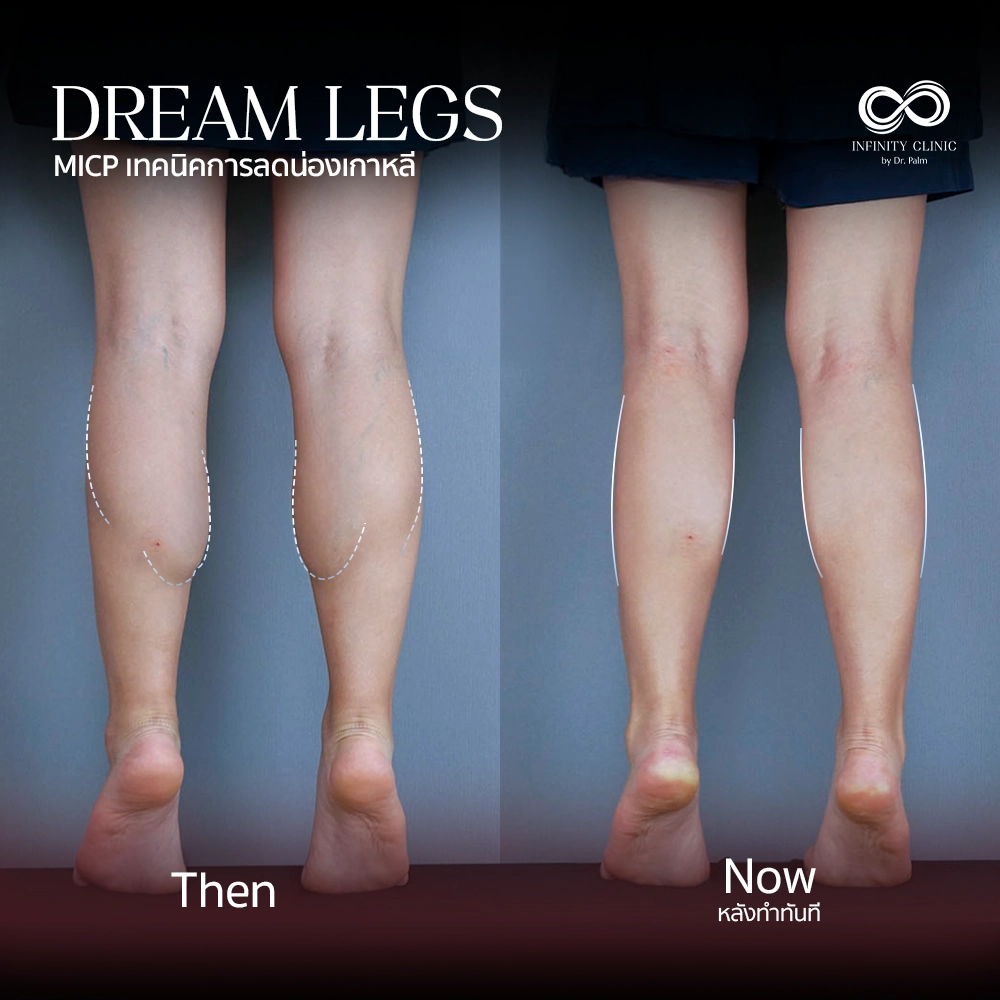 ภาพก่อน Dream Legs น่องใหญ่มีกล้ามเนื้อปูดชัดเจน และหลังทำทันที ไม่มีแผลเป็น