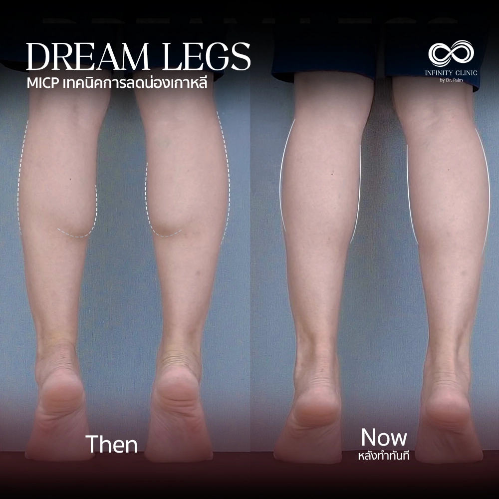 ภาพก่อน Dream Legs น่องใหญ่มีกล้ามเนื้อปูดชัดเจน และหลังทำทันที ไม่มีแผลเป็น