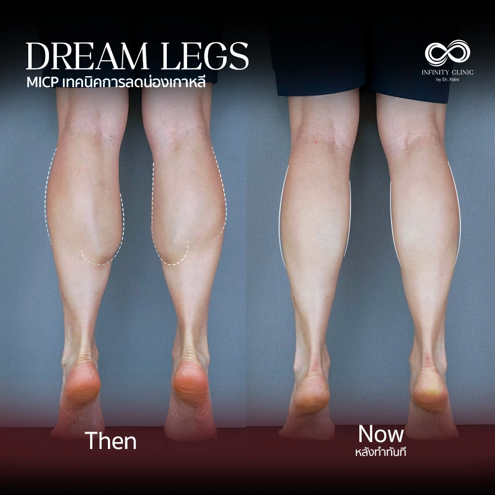 ภาพก่อน Dream Legs น่องใหญ่มีกล้ามเนื้อปูดชัดเจน และหลังทำทันที ไม่มีแผลเป็น