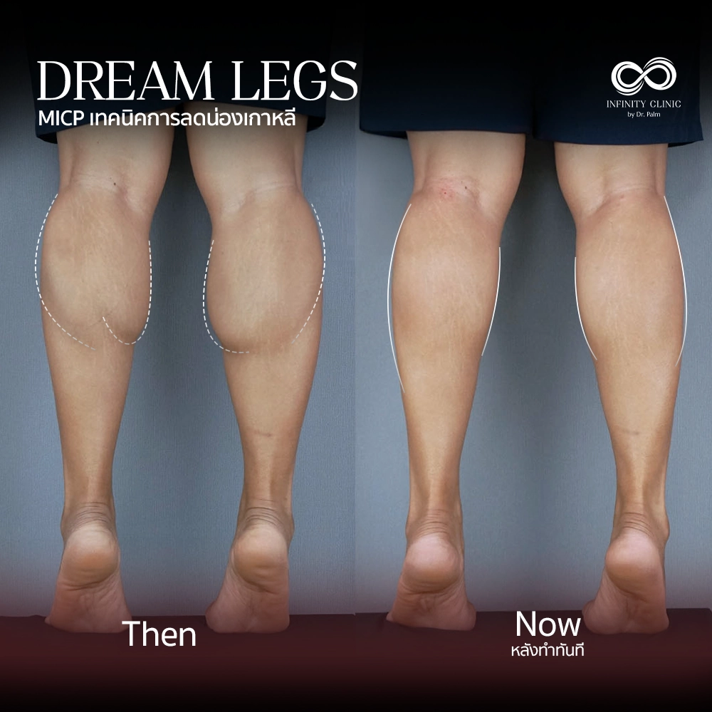 ภาพก่อน Dream Legs น่องใหญ่มีกล้ามเนื้อปูดชัดเจน และหลังทำทันที ไม่มีแผลเป็น