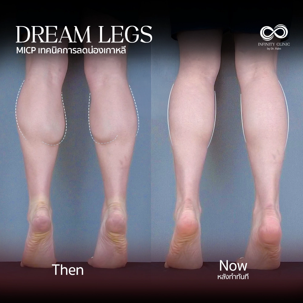 ภาพก่อน Dream Legs น่องใหญ่มีกล้ามเนื้อปูดชัดเจน และหลังทำทันที ไม่มีแผลเป็น