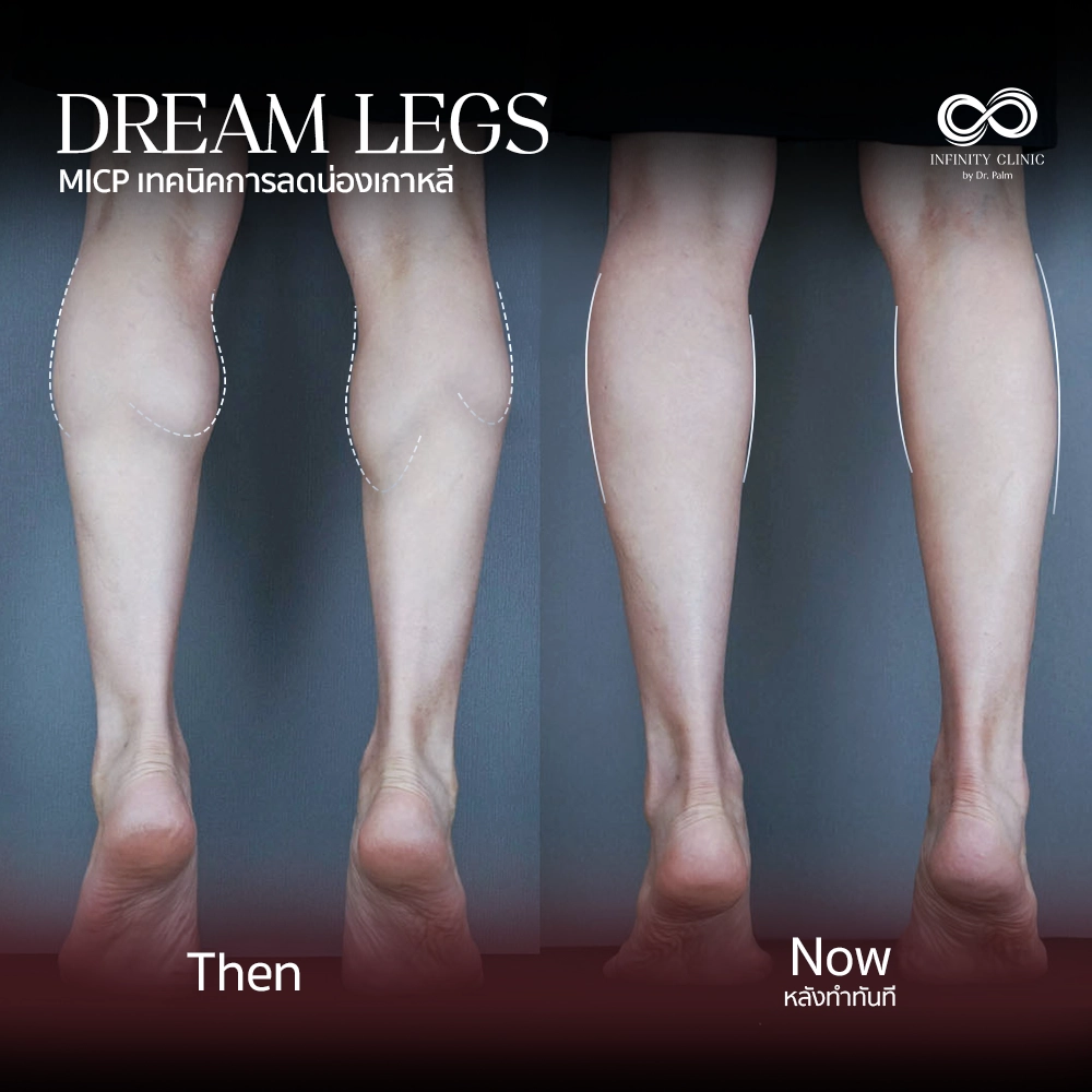ภาพก่อน Dream Legs น่องใหญ่มีกล้ามเนื้อปูดชัดเจน และหลังทำทันที ไม่มีแผลเป็น