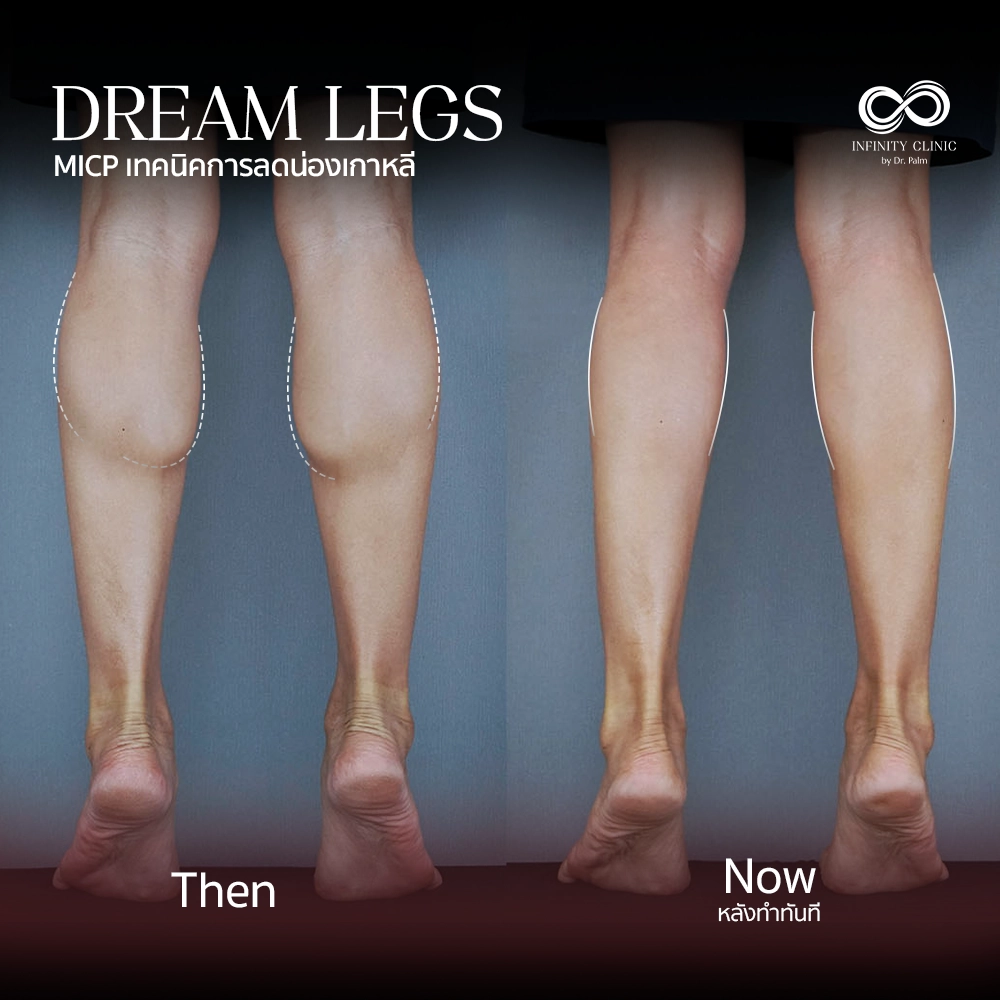 ภาพก่อน Dream Legs น่องใหญ่มีกล้ามเนื้อปูดชัดเจน และหลังทำทันที ไม่มีแผลเป็น