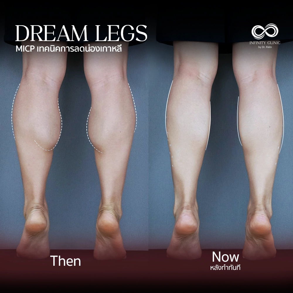 ภาพก่อน Dream Legs น่องใหญ่มีกล้ามเนื้อปูดชัดเจน และหลังทำทันที ไม่มีแผลเป็น