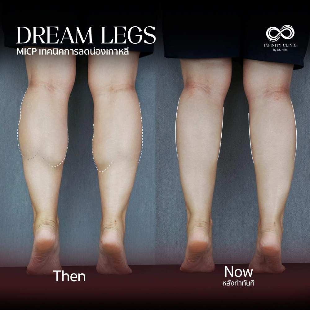 ภาพก่อน Dream Legs น่องใหญ่มีกล้ามเนื้อปูดชัดเจน และหลังทำทันที ไม่มีแผลเป็น