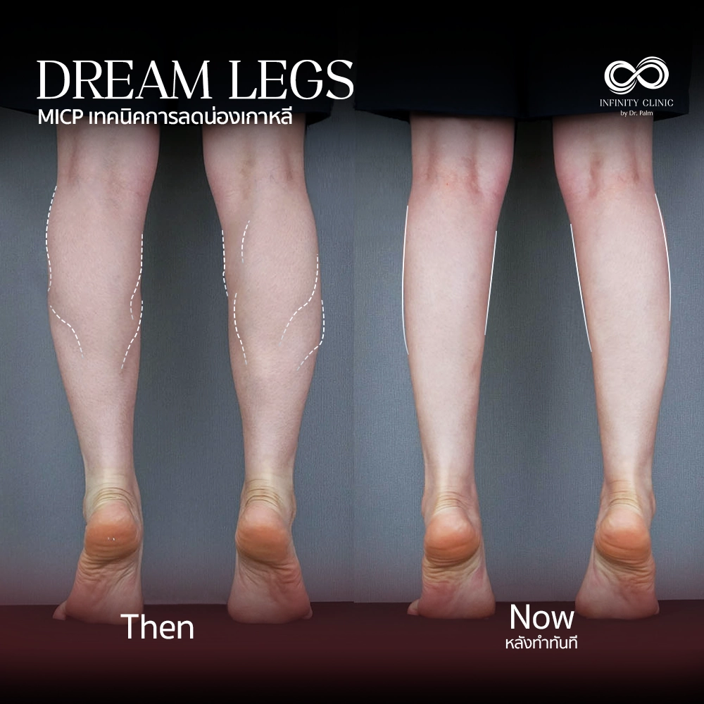 ภาพก่อน Dream Legs น่องใหญ่มีกล้ามเนื้อปูดชัดเจน และหลังทำทันที ไม่มีแผลเป็น