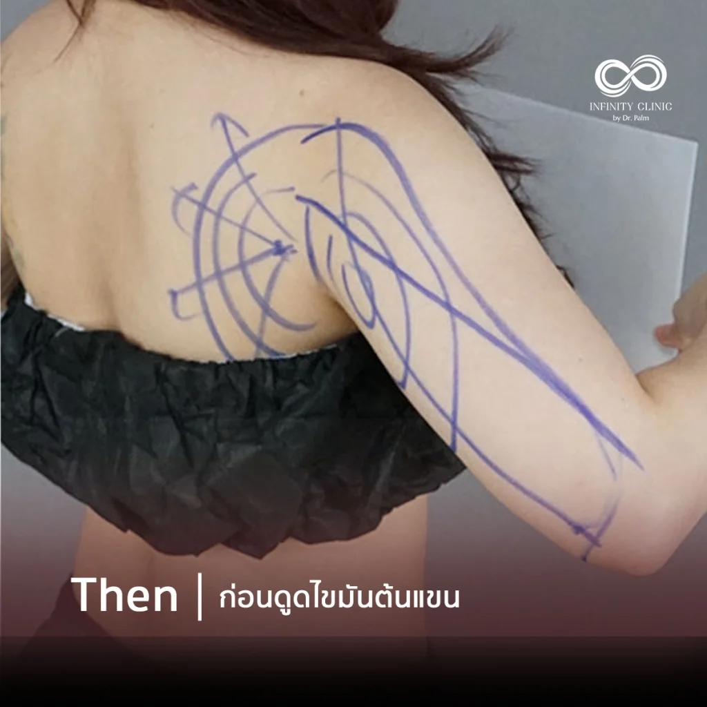 รีวิวผลการดูดไขมัน Responsive Liposuction ด้านหน้าและด้านหลัง