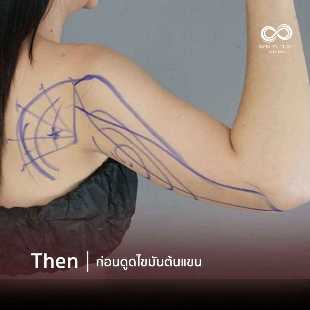 รีวิวผลการดูดไขมัน Responsive Liposuction ด้านหน้าและด้านหลัง