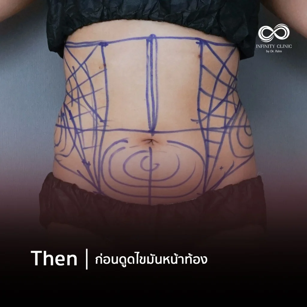ก่อนหลัง Responsive Liposuction ดูดไขมันเวเซอร์