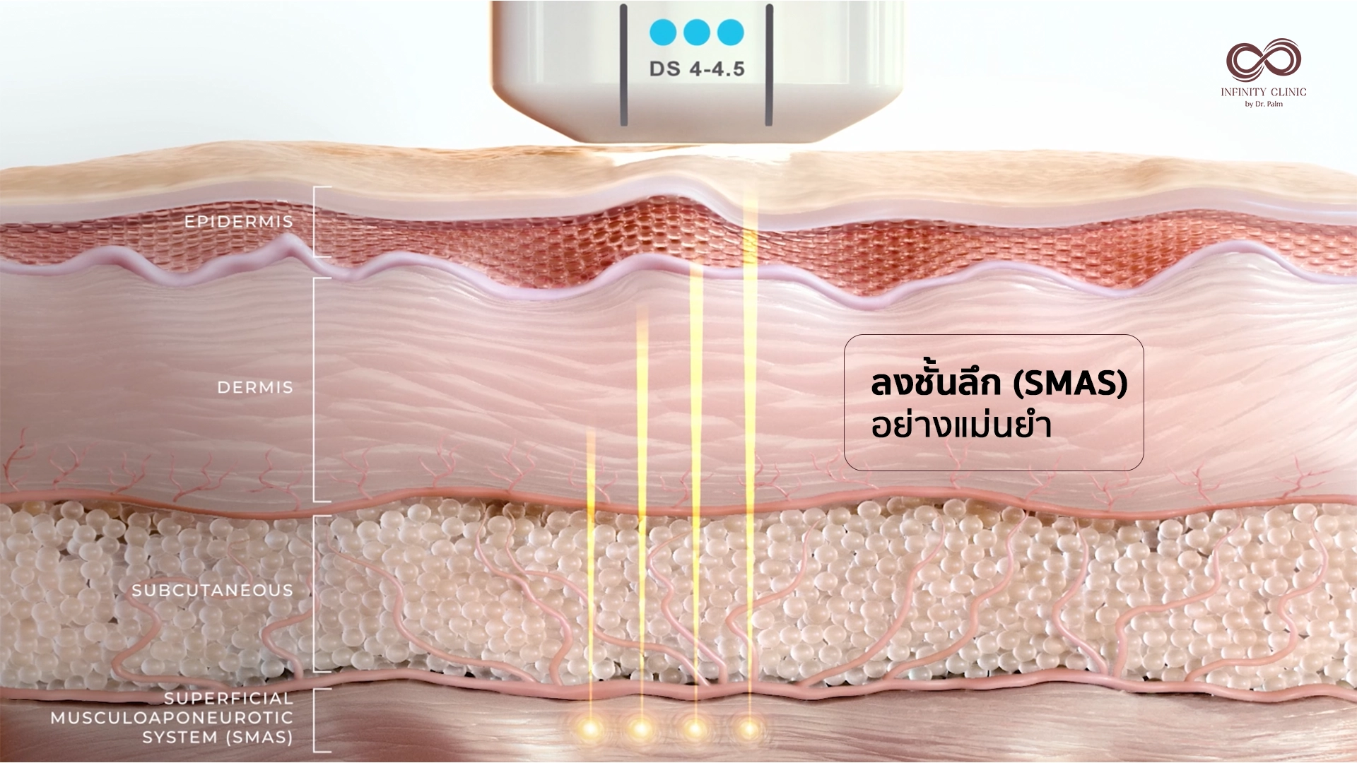 ภาพเครื่อง Ulthera Prime และระบบมองเห็นชั้นผิวเรียลไทม์