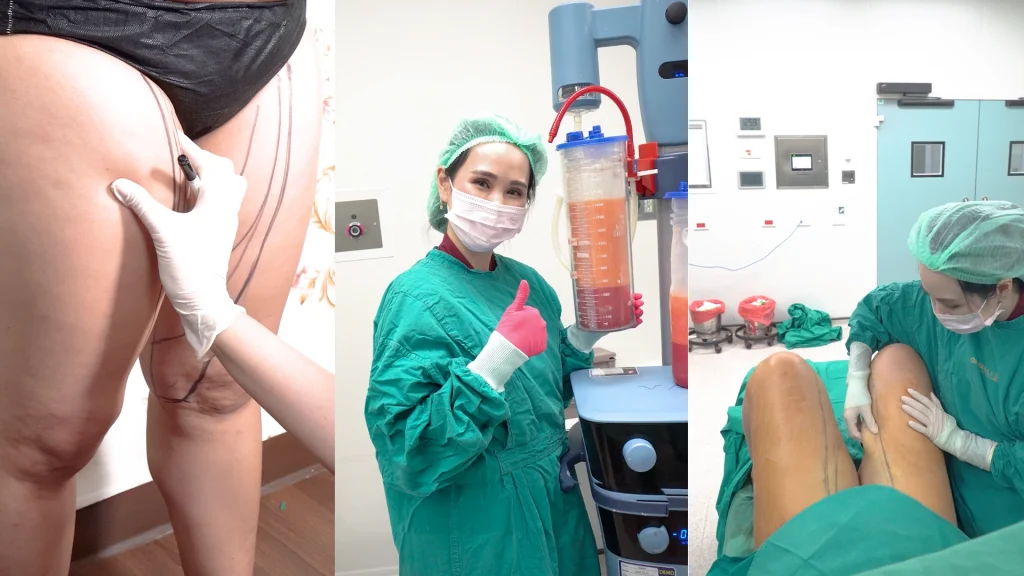คุณหมอปาล์ม พญ. ชวนัฐดา เกยานนท์ ให้คำปรึกษา Responsive Liposuction